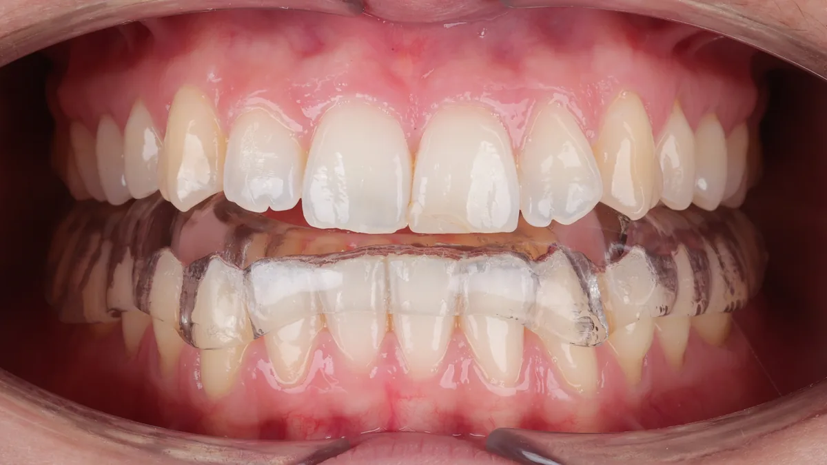 Férula oclusal transparente colocada sobre los dientes de un paciente con disfunción temporomandibular